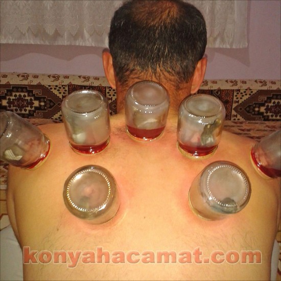 KESKİNOĞLU hacamat tedavisi s&uuml;l&uuml;k kursu Konya